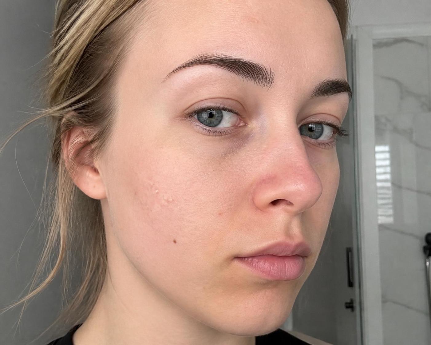 découvrez les causes des petits boutons blancs après l'épilation du visage et apprenez les solutions efficaces pour les prévenir et les traiter facilement.
