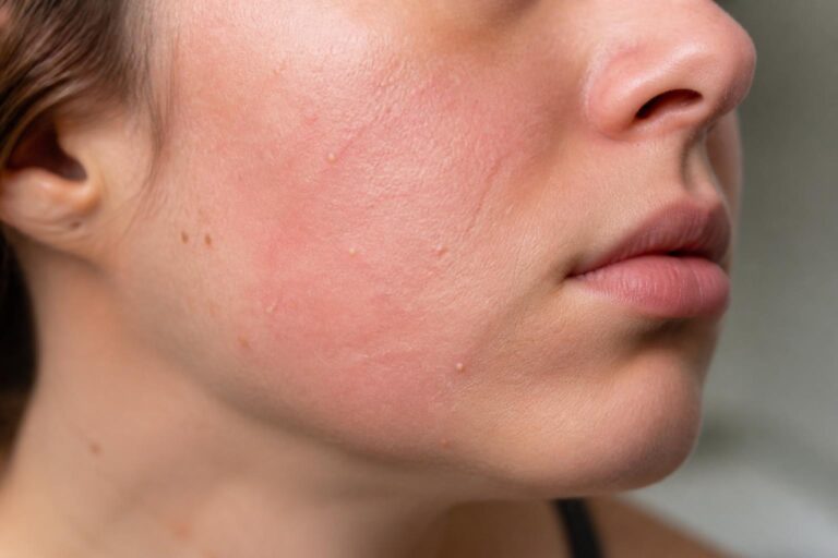 découvrez les causes des petits boutons blancs après l'épilation du visage et les solutions efficaces pour les prévenir et les traiter, pour une peau douce et nette.