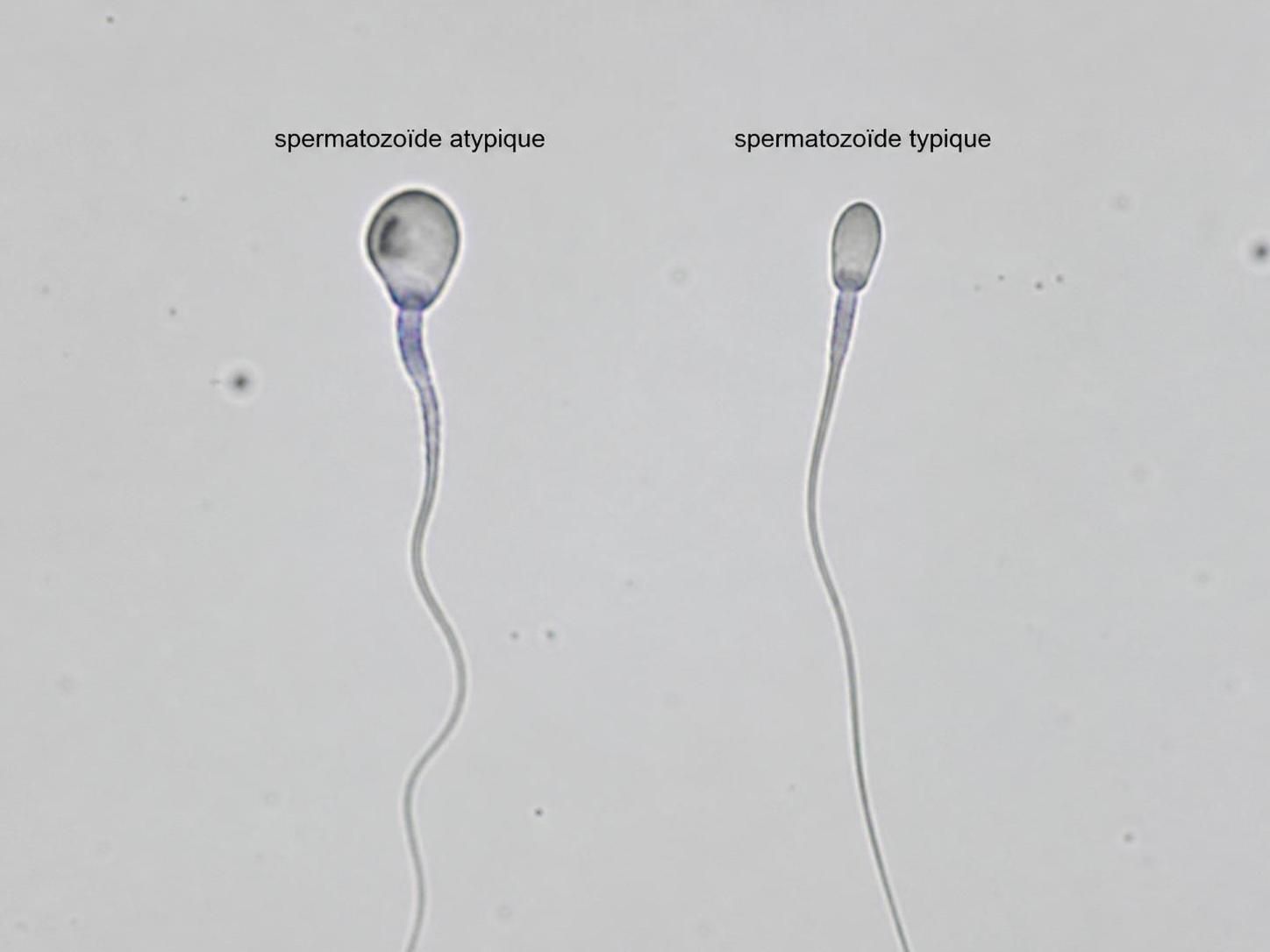 découvrez le rôle des spermatozoïdes atypiques dans la fécondation et explorez comment ces formes inhabituelles pourraient influencer la fertilité et offrir de nouvelles perspectives en reproduction.